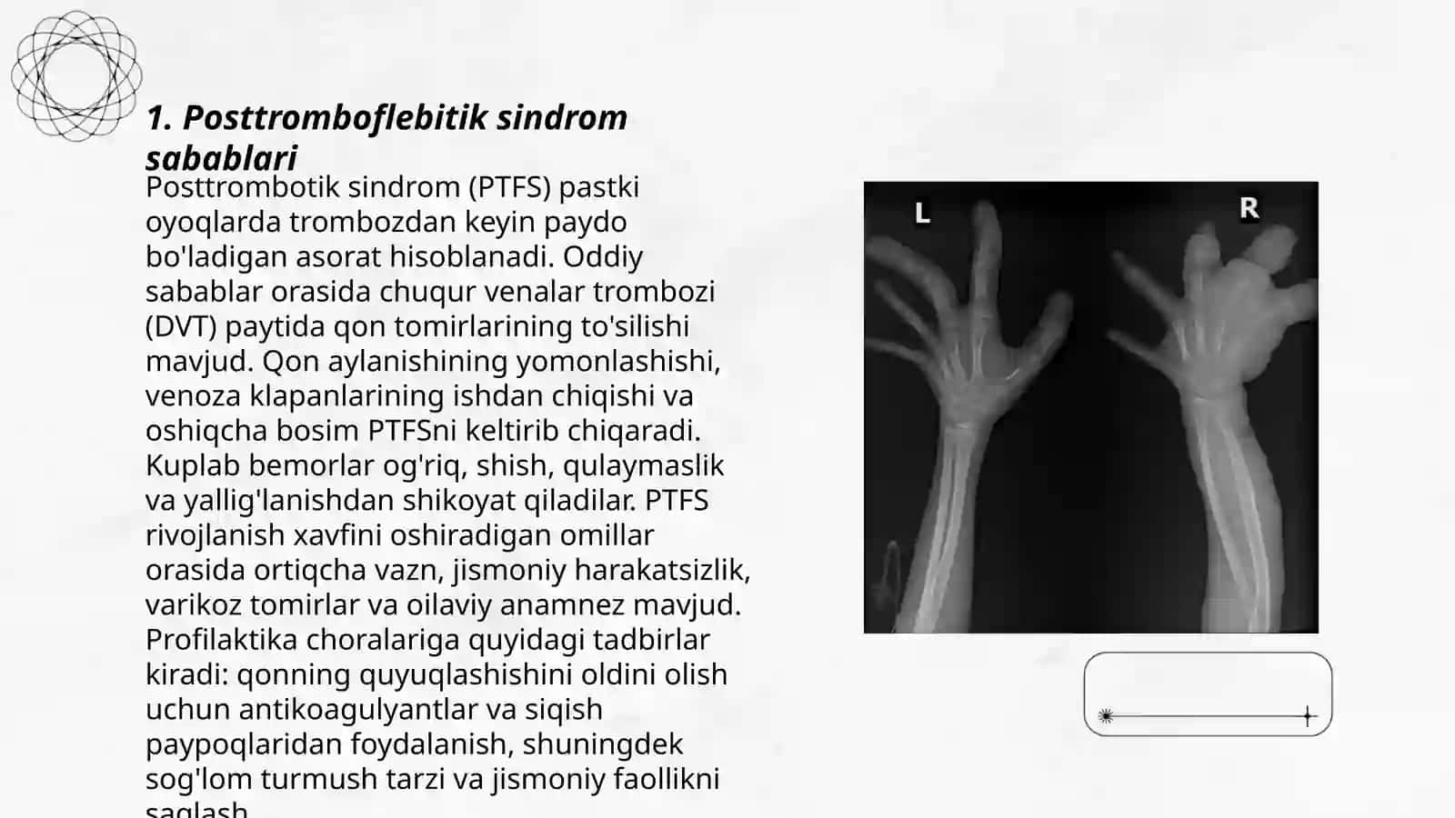Posttromboflebitik sindrom 3