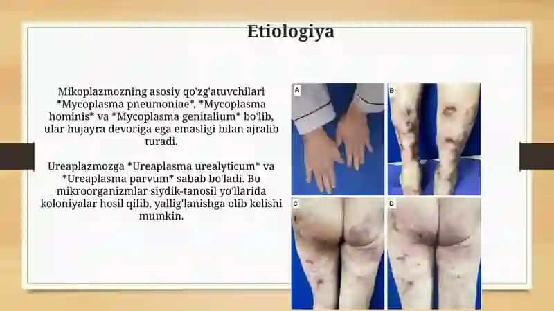 Mikoplazmoz va ureaplazmoz 3