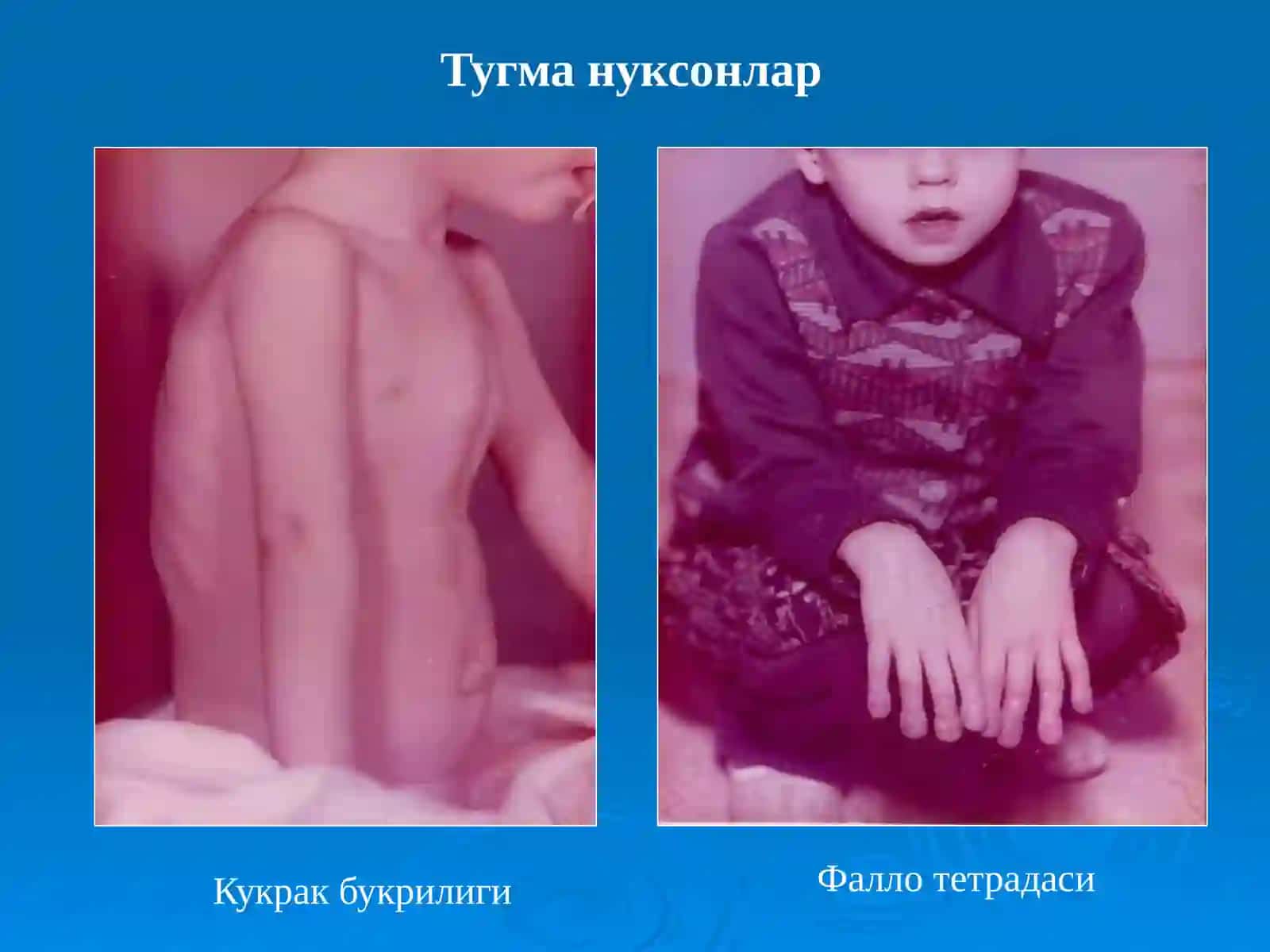 Туғма юракнуқсонлари 3