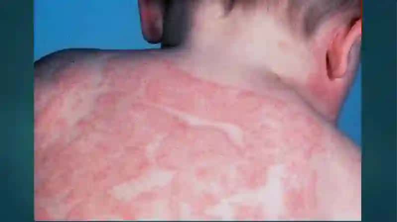 Atopikdermatitlar 3
