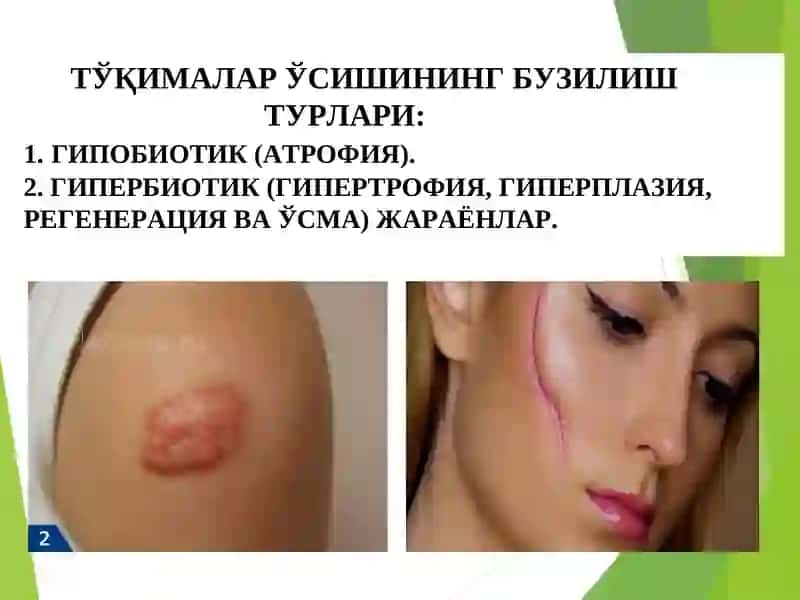 ТЎҚИМА ЎСИШИНИНГ ПАТОФИЗИОЛОГИЯСИ 3