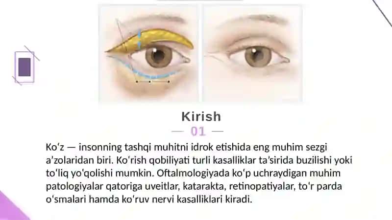Mavzu:Uveit. Katarakta. Retinopatiyalar. To'r parda o'smalari. Ko'ruv nerv patologiyaları. 3