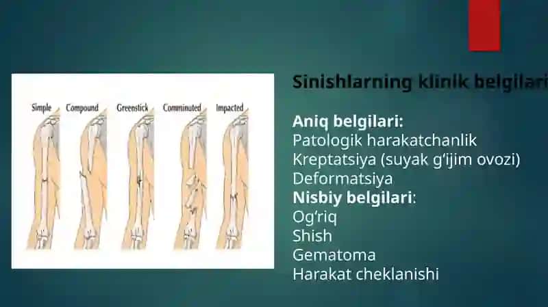 Oyoq-qo‘llar sinishlarni yopiq repozitsiyasi. Gips texnikasi. (Gips xonada ishlash). Skelet va leyko 3