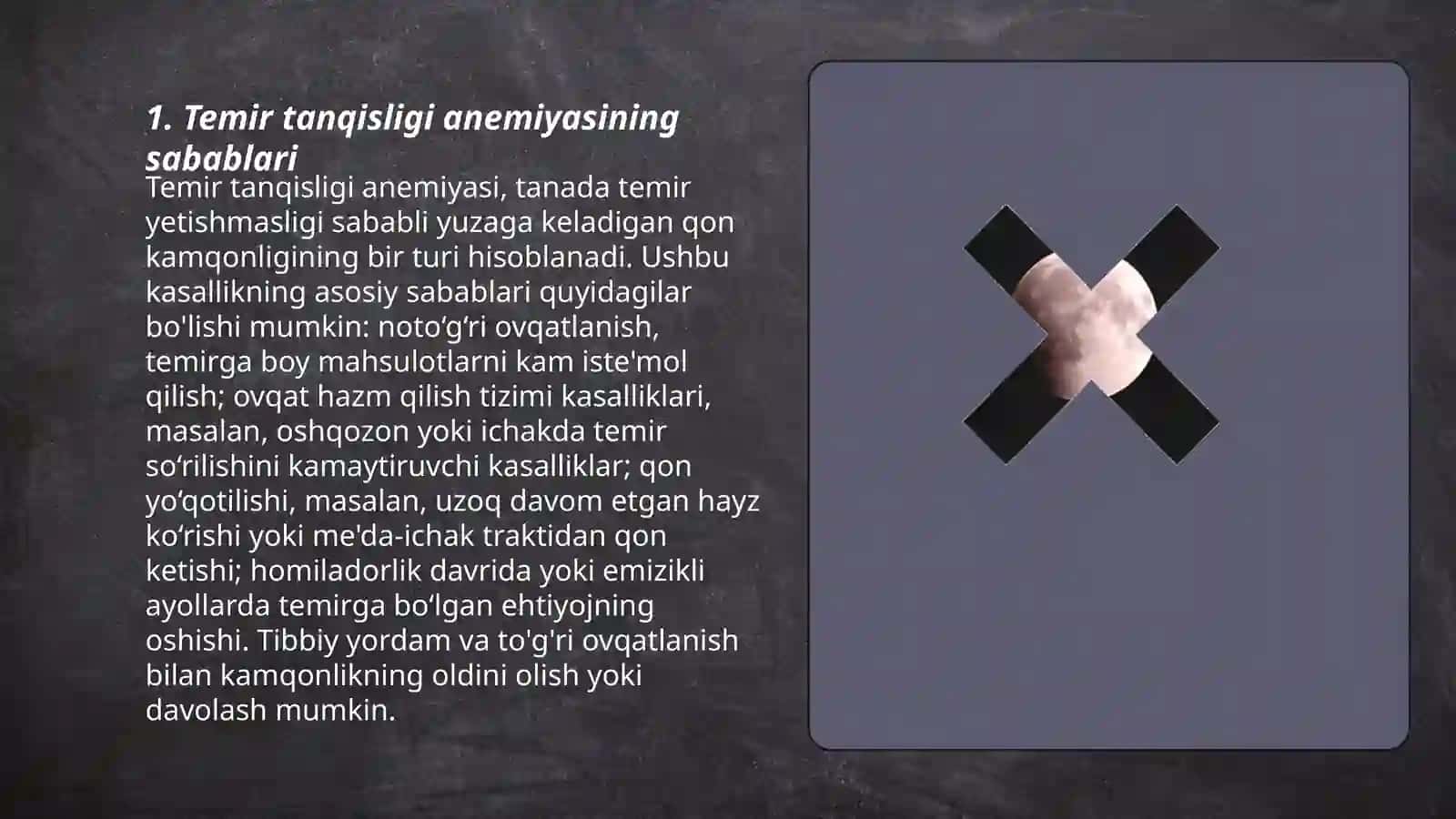 Temir tanqisligi anemiyasi 1 va 2 og‘irlik darajalarini davolash va profilaktika prinsiplari 3