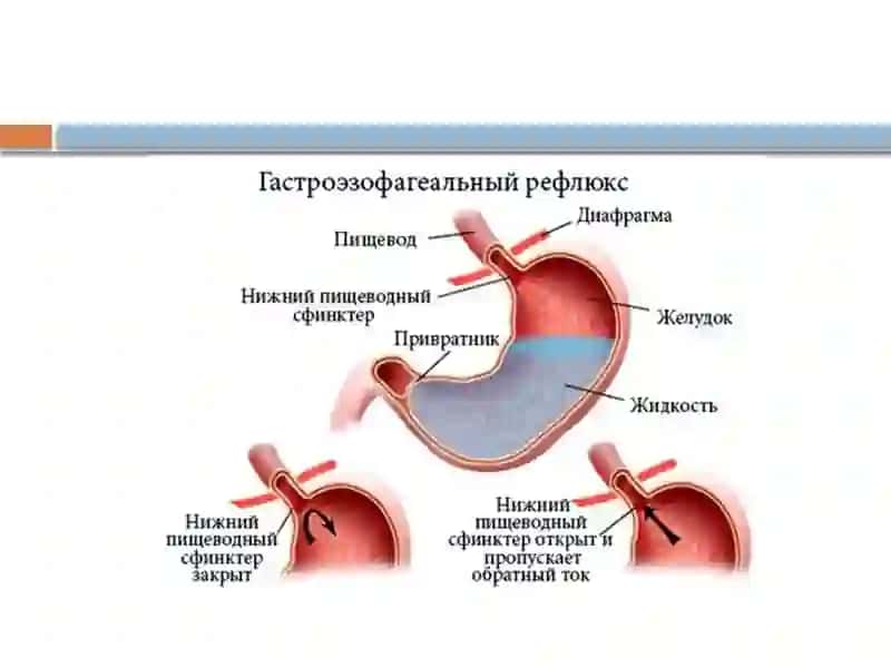 Gastroezofagial refluks kasalligi 3