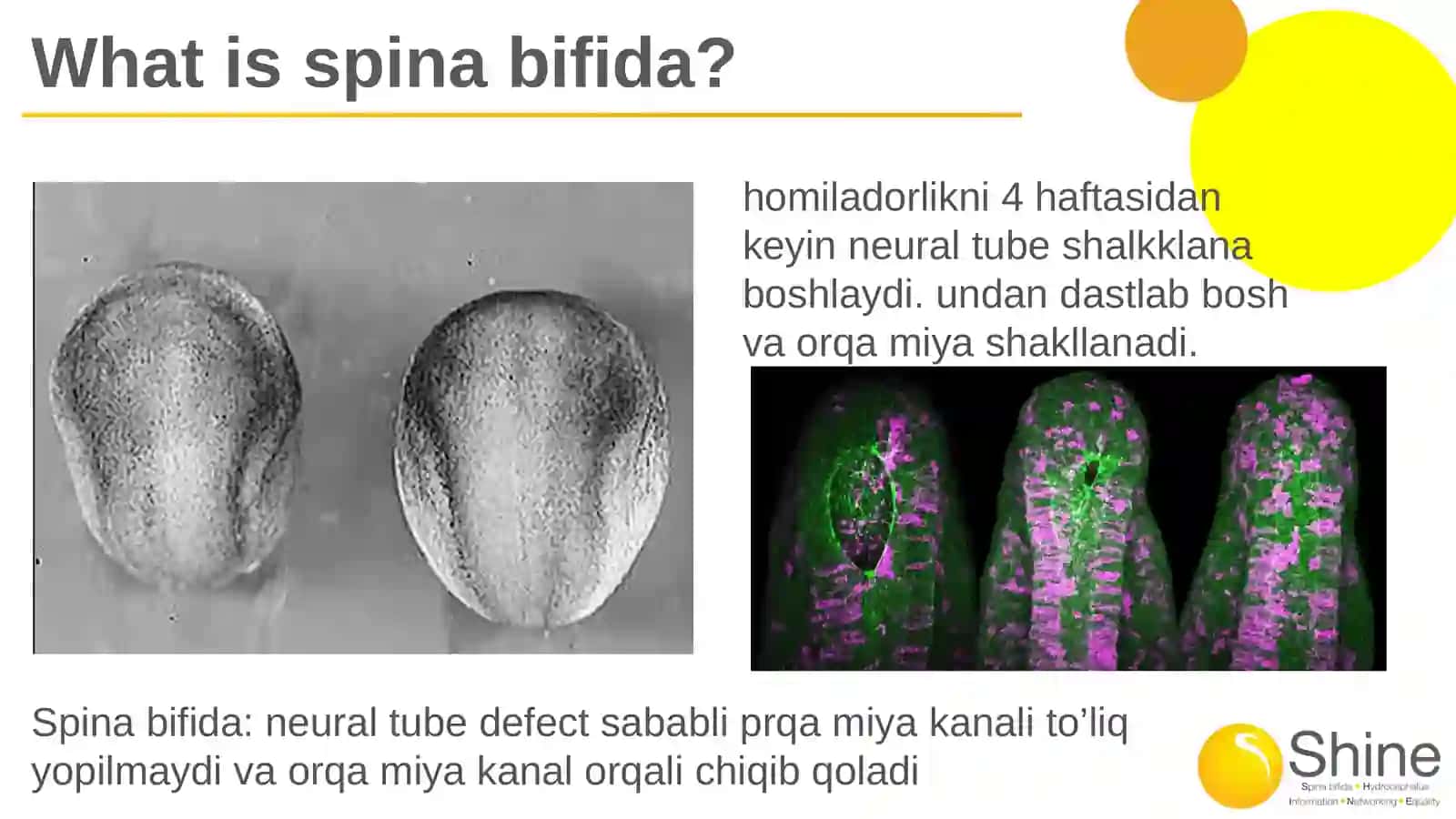 Spinabifida 3