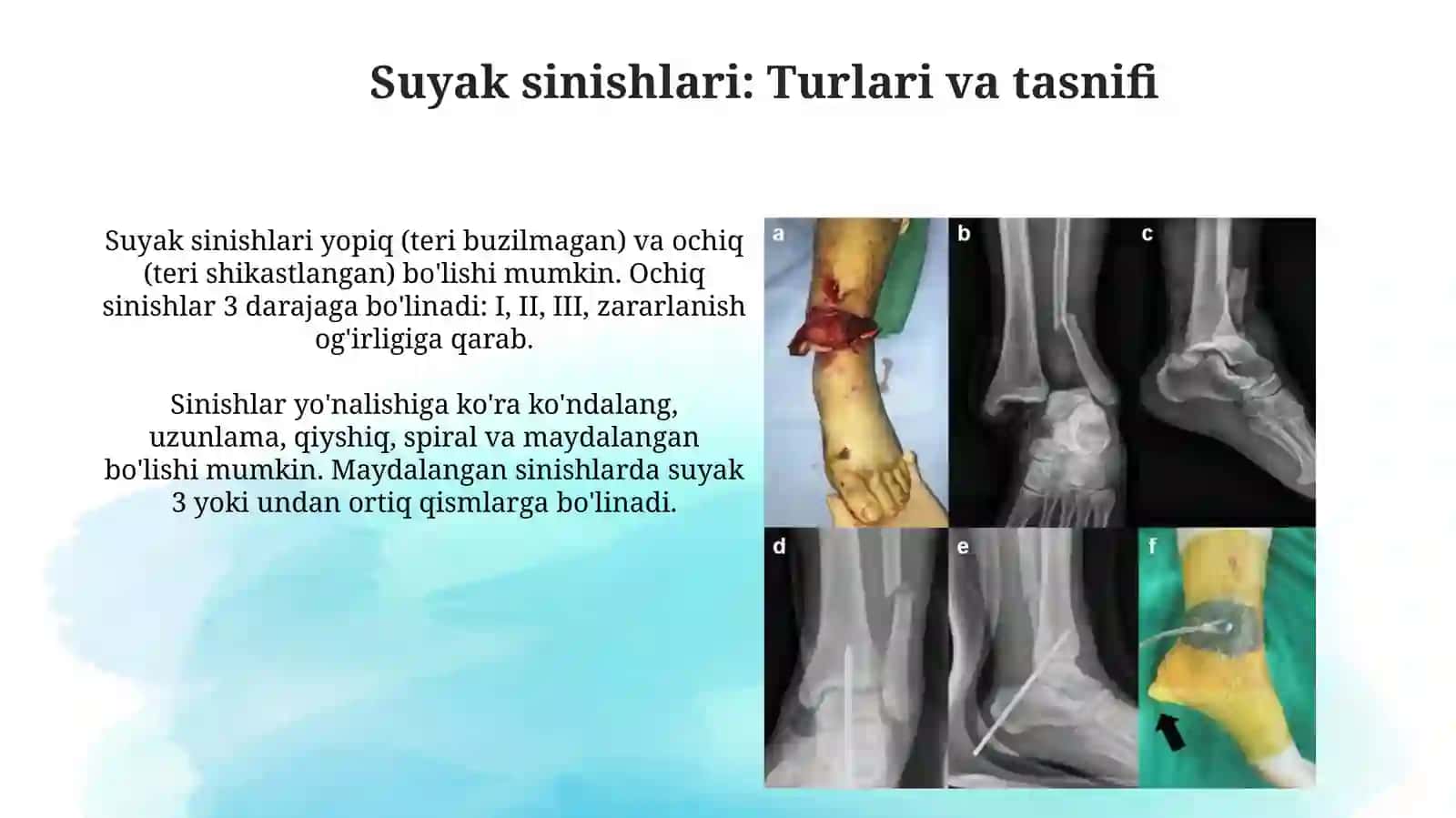 Suyaklar sinishi va boʻgʻimlar chiqishi.Transportimmobilizatsiyatsiyasi.Yatrogeniya 3
