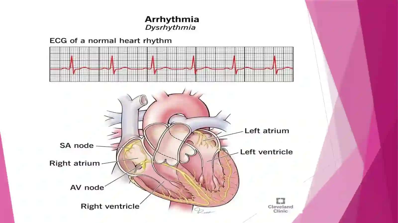 YurakaritmiyalariEKG diagnostikasi 3