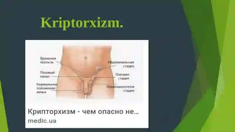 Kriptorxizm. Etiopatogenezi, klinikasi, diagnostikasi, davolash 3