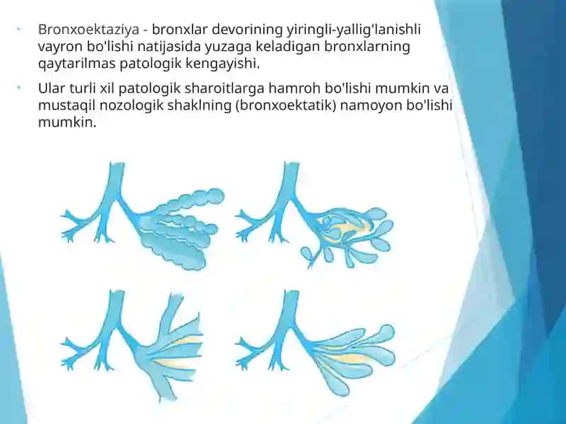 Bronxoektazkasallik 3