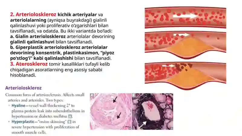 PATOLOGIYA Qontomirkasalliklari Leksiya 3