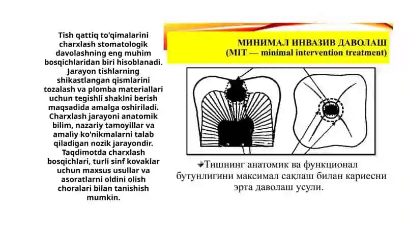 Tish qattiq to'qimalarini charxlashning minimal invasiv usullari 3