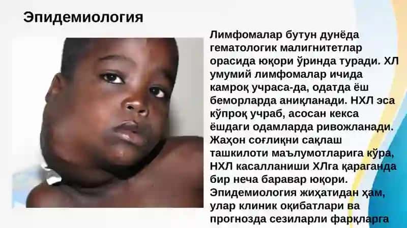 Ходжкин ва Ноходжкин лимфомалари . Xodjkin va Noxodjkin limfomalari 3
