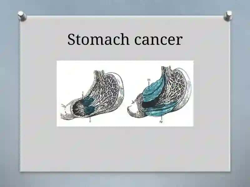 Stomach cancer 3