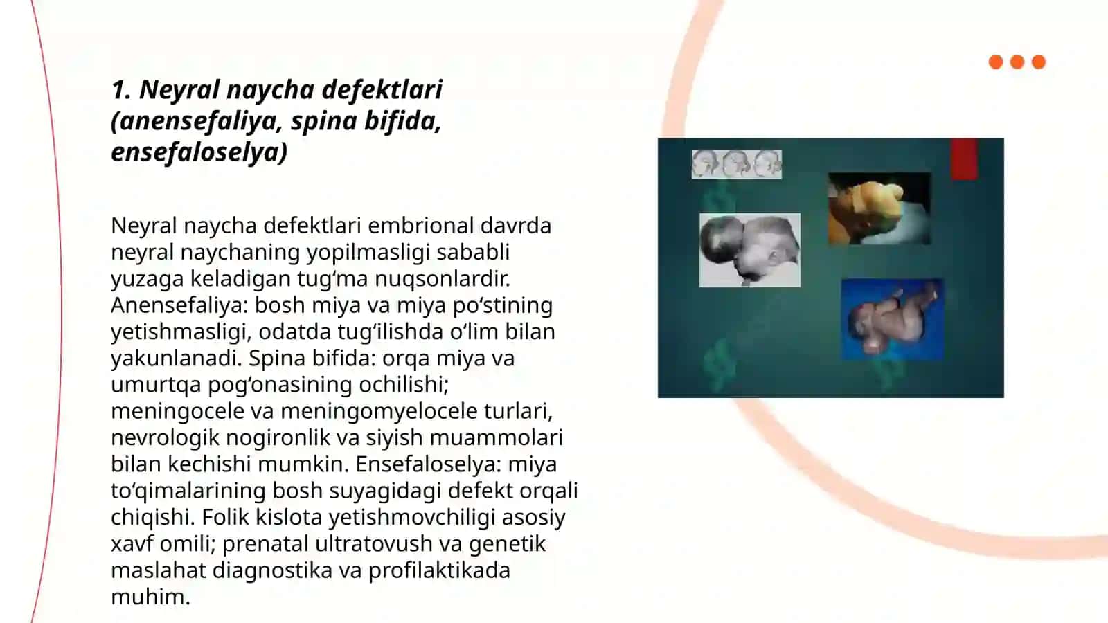 Bosh miya va orqa miya tug‘ma rivojlanish nuqsonlari 3