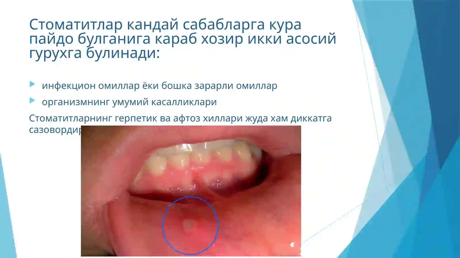 Стоматит 3