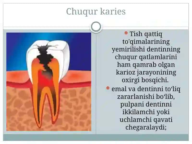 Chuqur karies 3