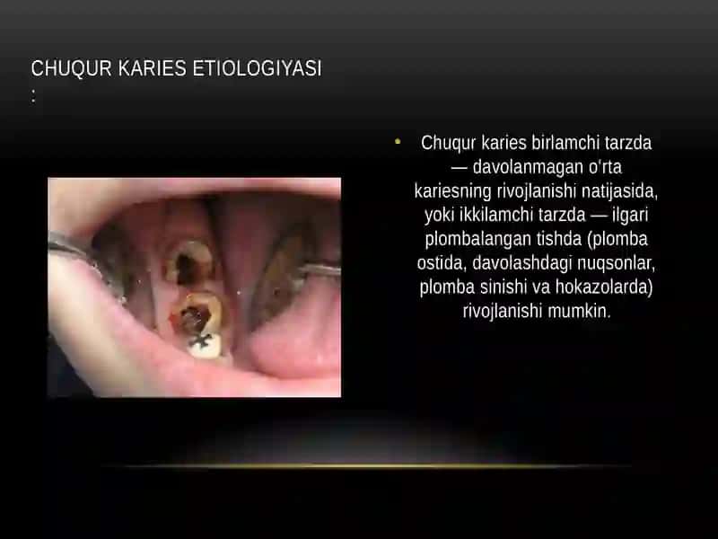 CHUQUR KARIES. O`TKIR VA SURUNKALI SHAKLLARINI KLINIK KECHISHI, TASHXISLASH.

QIYOSIY TASHXISI.FIZIK 3