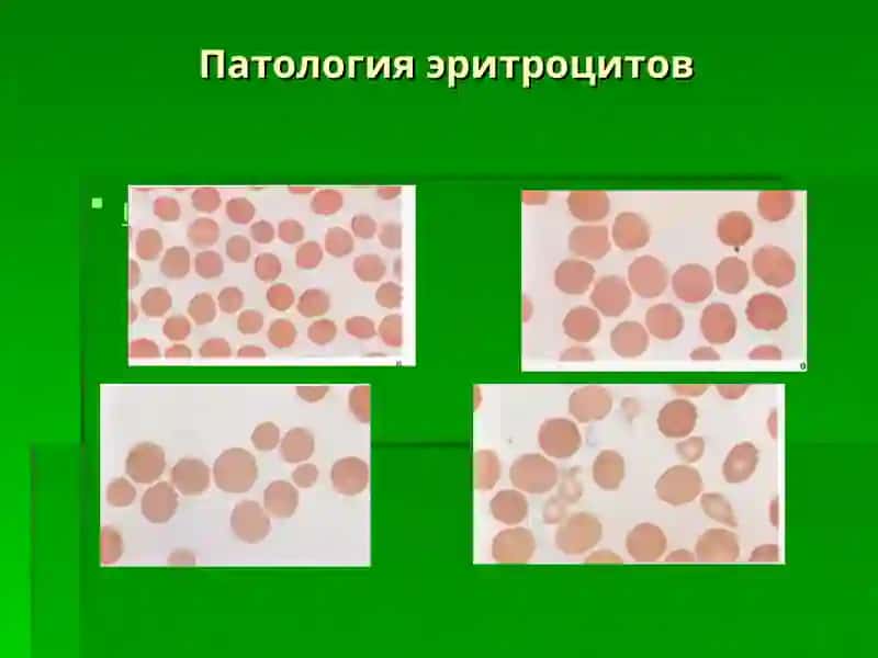 АНЕМИЯ 3