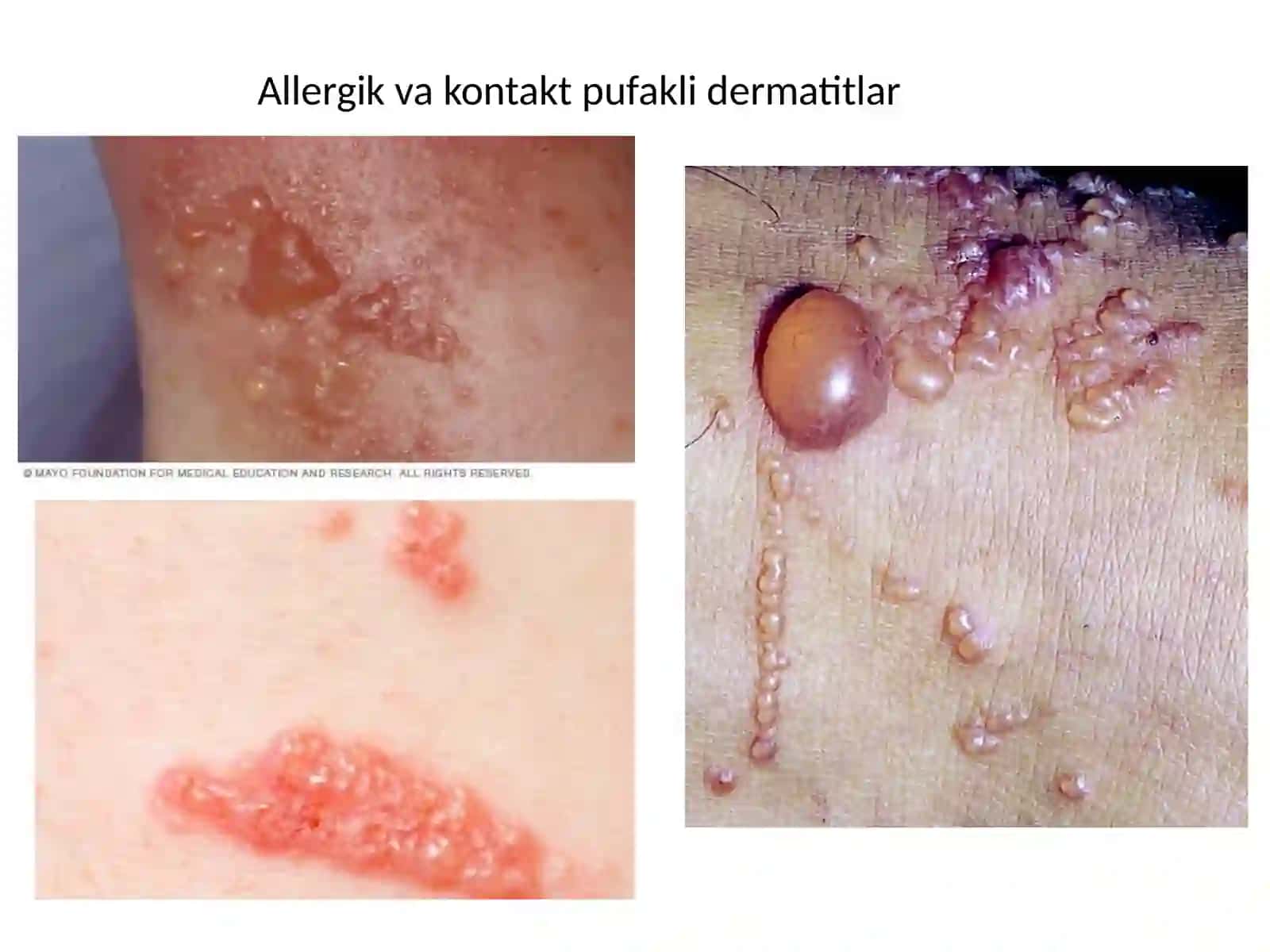 Pufakli dermatitlar klassifikatsiyasi. Diuring dermatiti, po’rsildoq yara 3