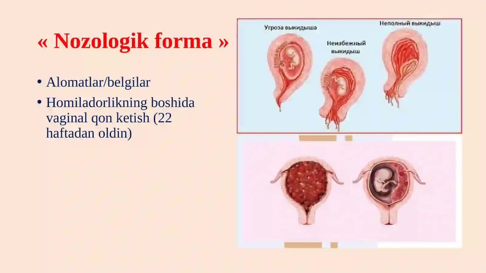 Homiladorlikning 22 haftaligiga qadar qon ketishi bo'lgan homilador ayollarni davolash 3