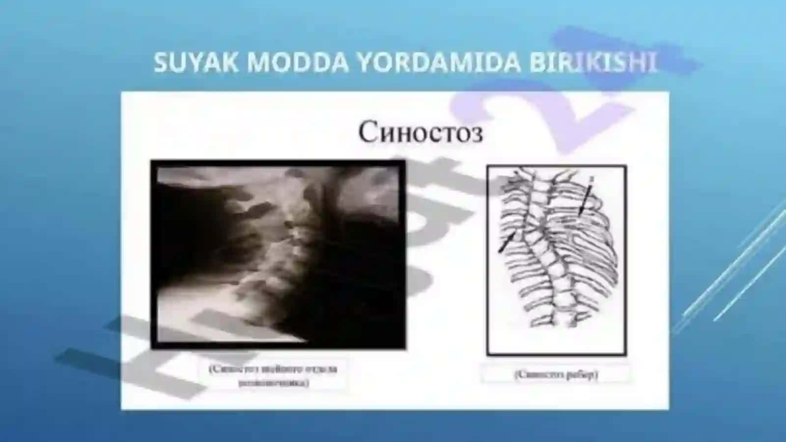 Sindesmoz, sinxondroz,sinostoz birlashuvlar 3