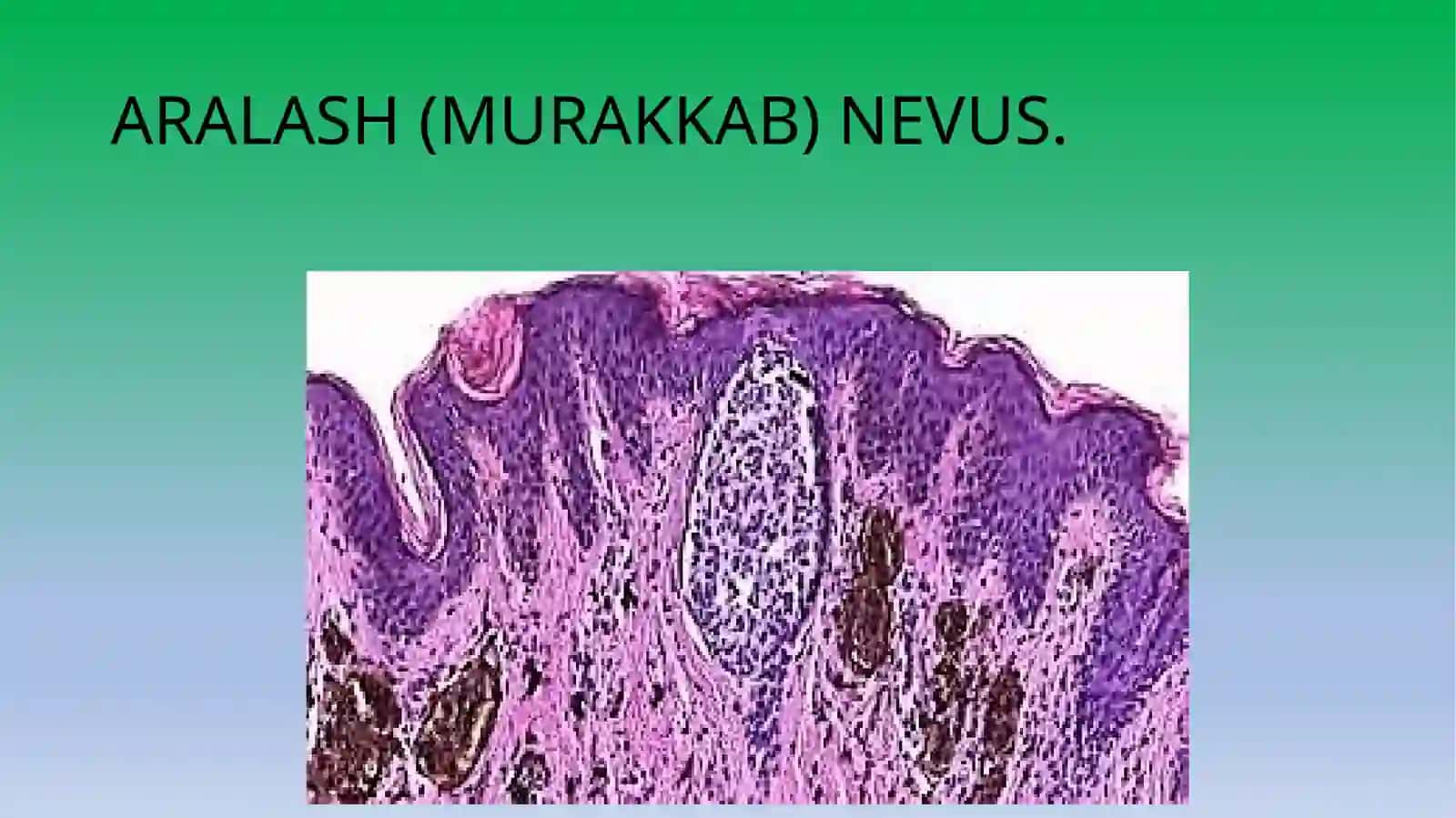 Chegaradagi nevus 3