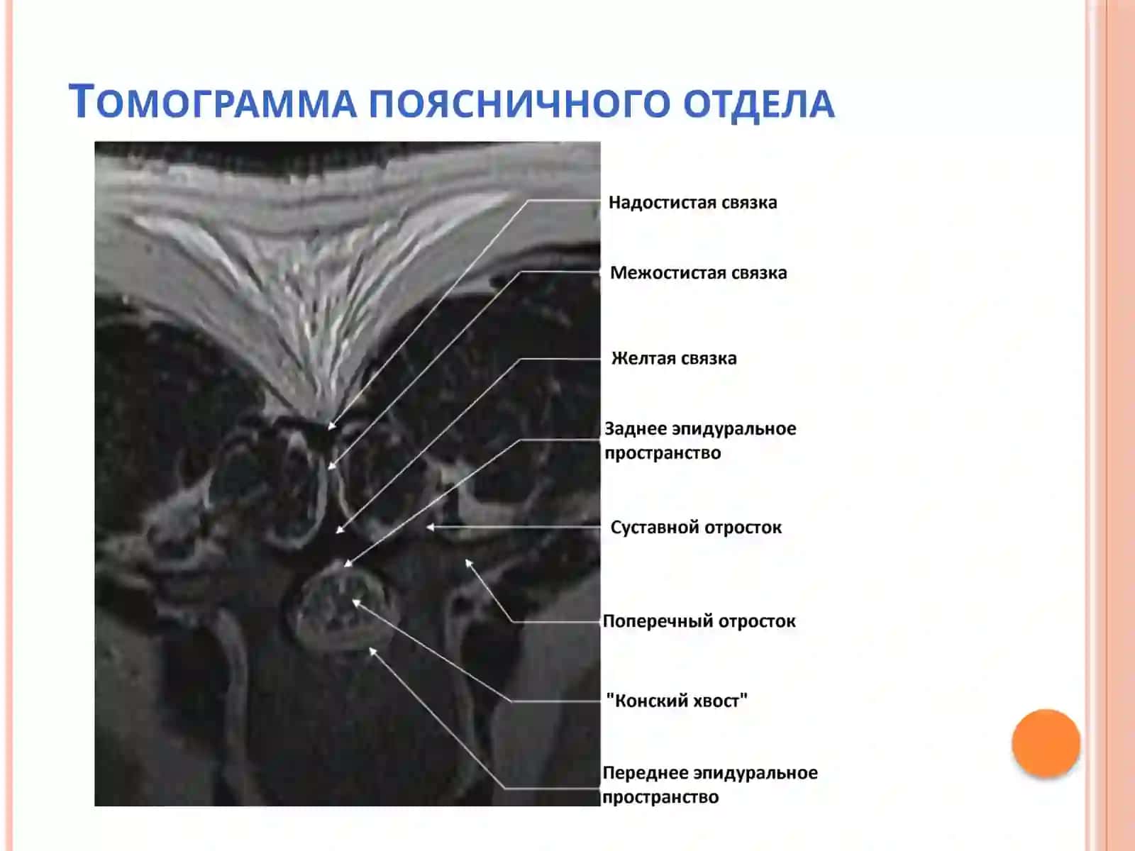Ультразвуковая визуализация позвоночника 3