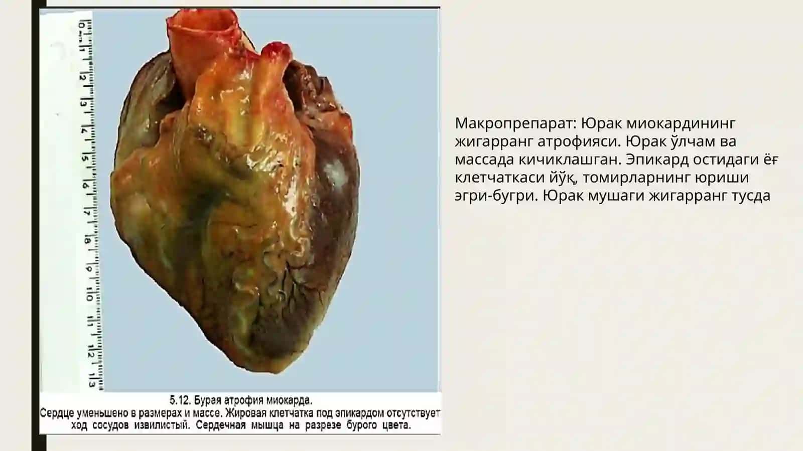 Макропрепарат: Сурункали атрофик гастрит. Микропрепарат: Буйрак амилоидози 3