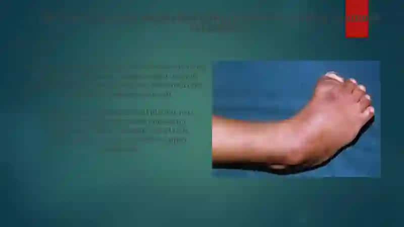 Qoʻl va oyoq terisi mushaklarining innervatsiyasining anatomik variantlari 3