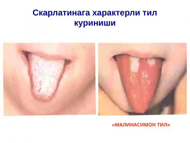 СКАРЛАТИНА 3