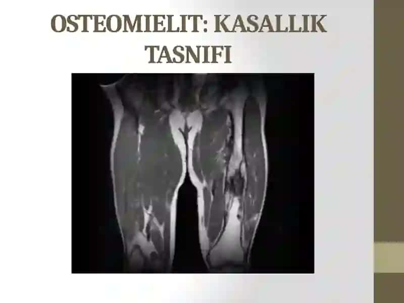 SurunkaliOsteomielit:Sabablari,Belgilari,Tashxis,Davolash 3