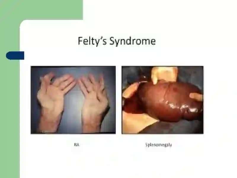 Feltisindromi 3