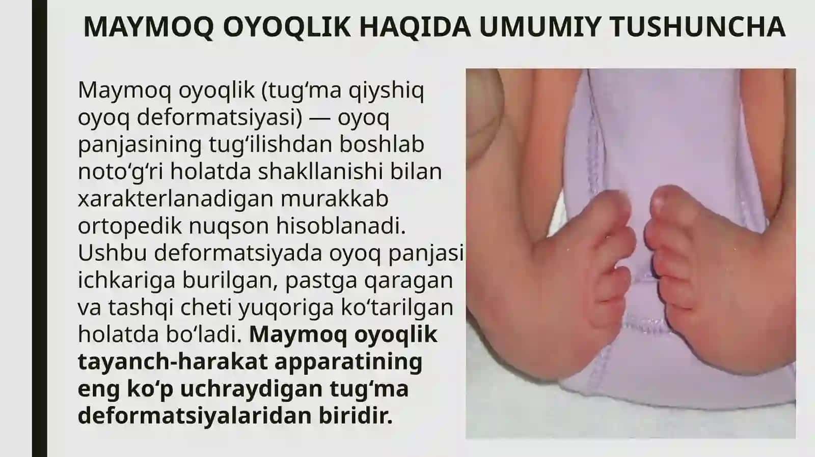 MAYMOQ OYOQLIK (TUG‘MA QIYSHIQ OYOQ — CLUBFOOT) 3