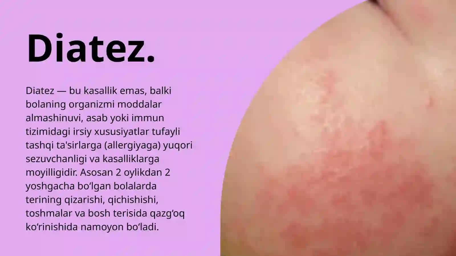 Bolalarda konstitutsiya anomaliyalari. Diatezlar. 3