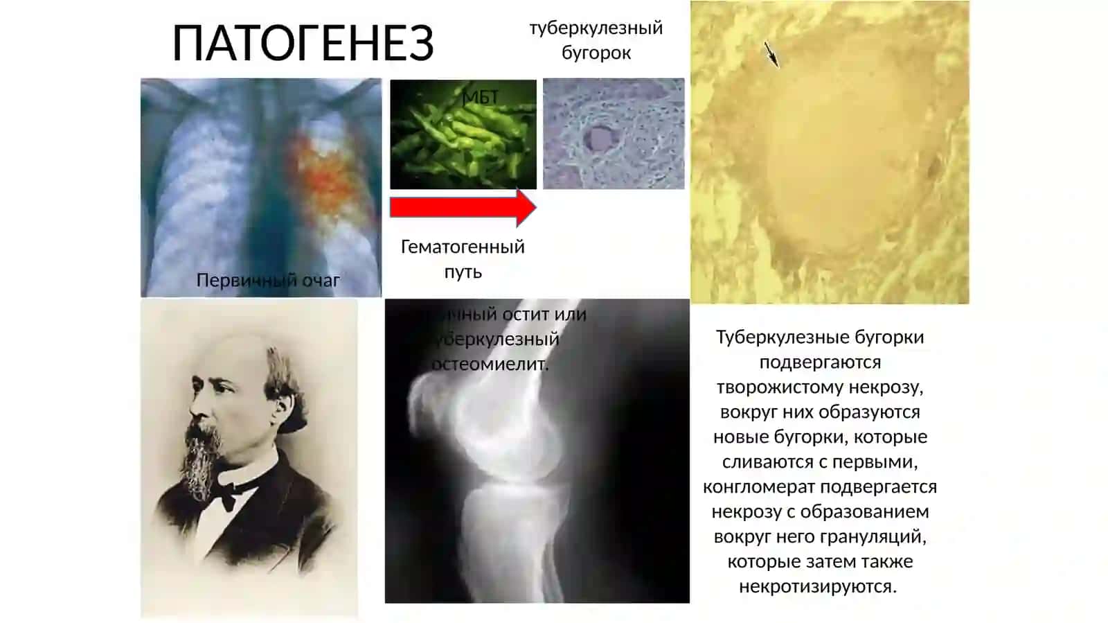 Хирургический туберкулёз 3