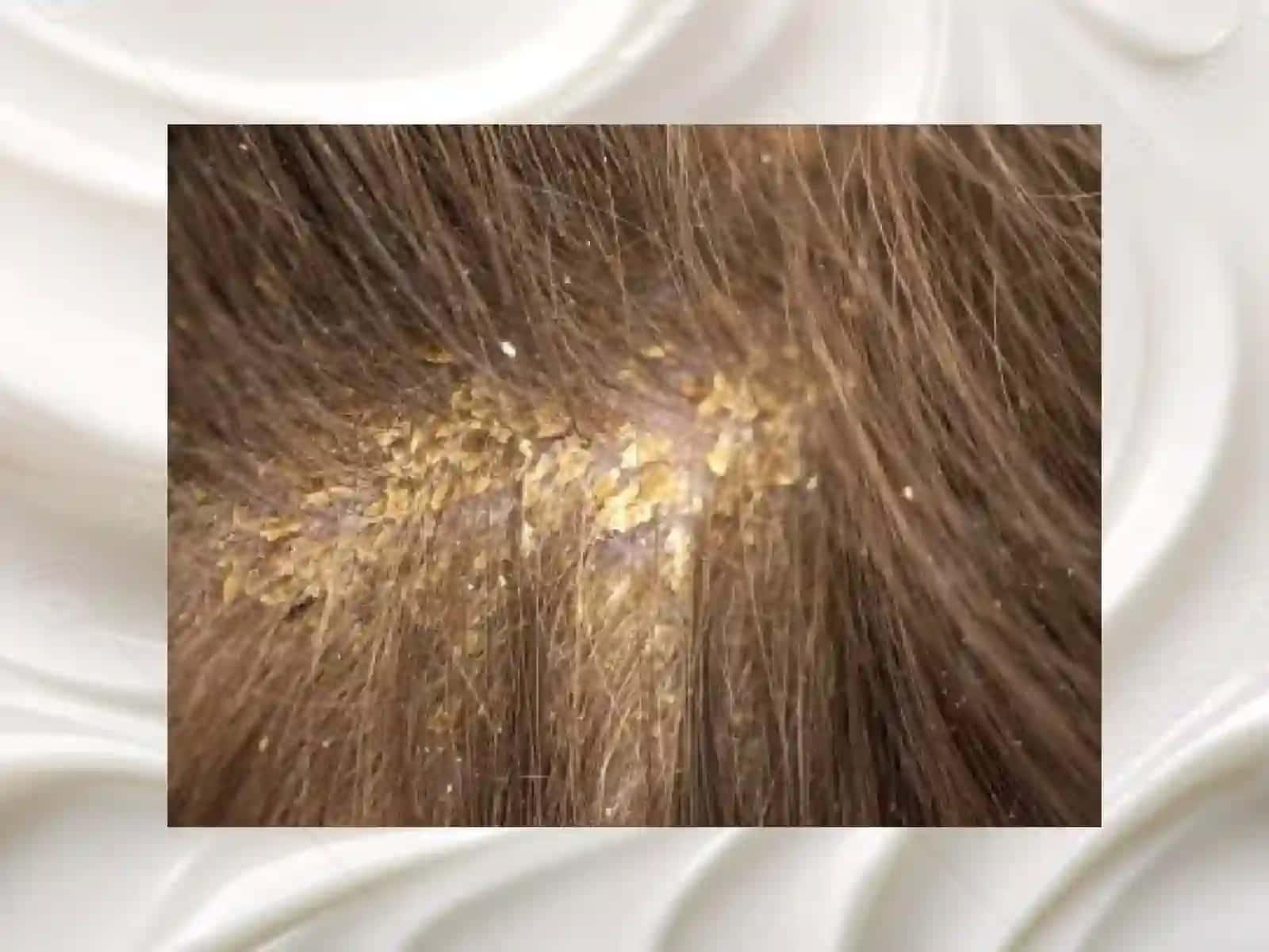 Dermatovenerologiya fanidan Seboreya va Pushti rangli xusn buzargalarning davolash usullari 3