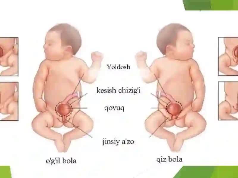 Uretra va moyaklar tug'ma nuqsonlari 3