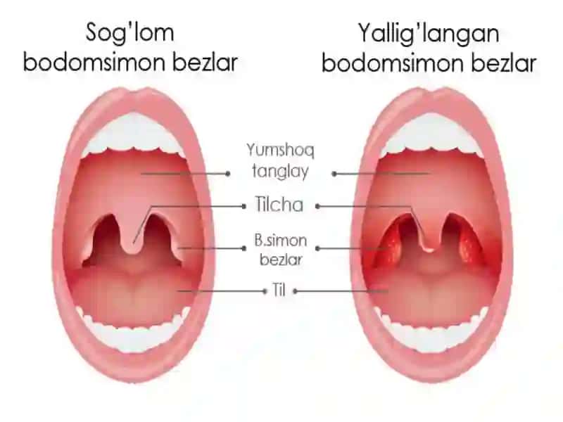 RESPIRATOR VA ANGINASINDROMI BILAN KECHADIGAN KASALLIKLAR 3