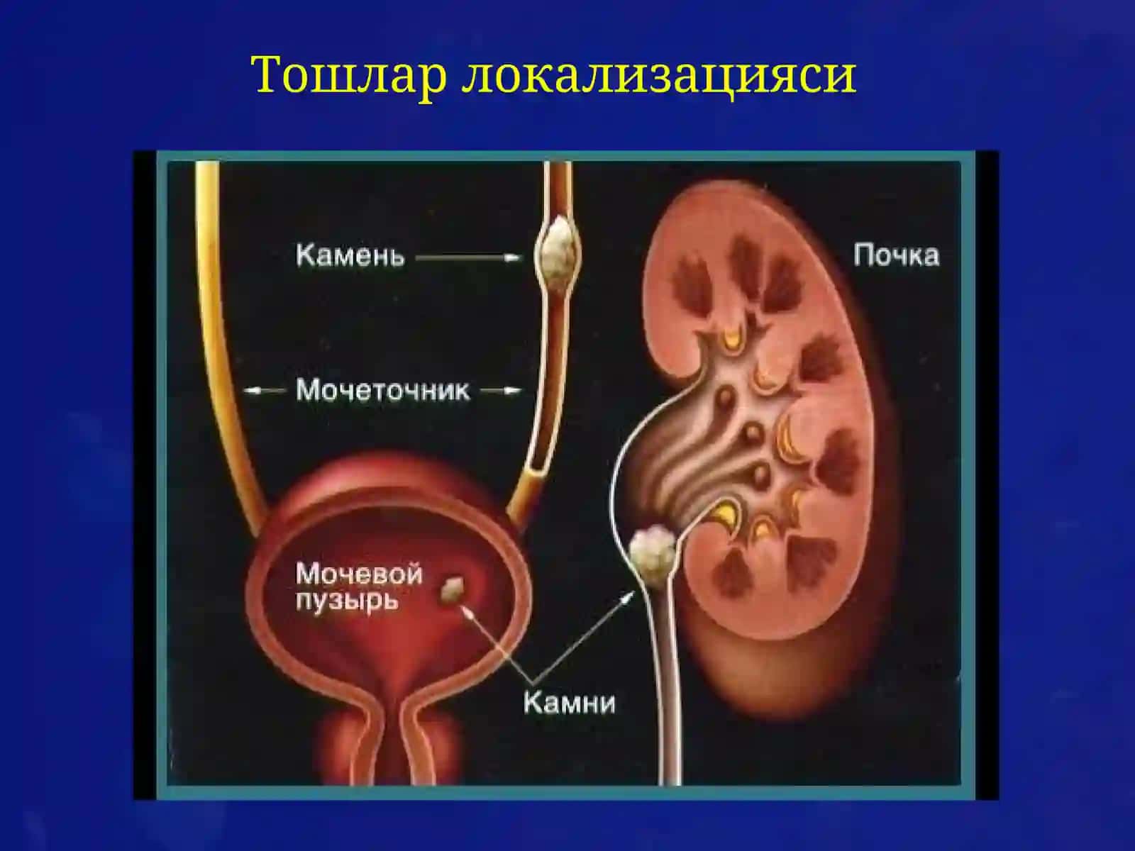 У Р О Л И Т И А З 3