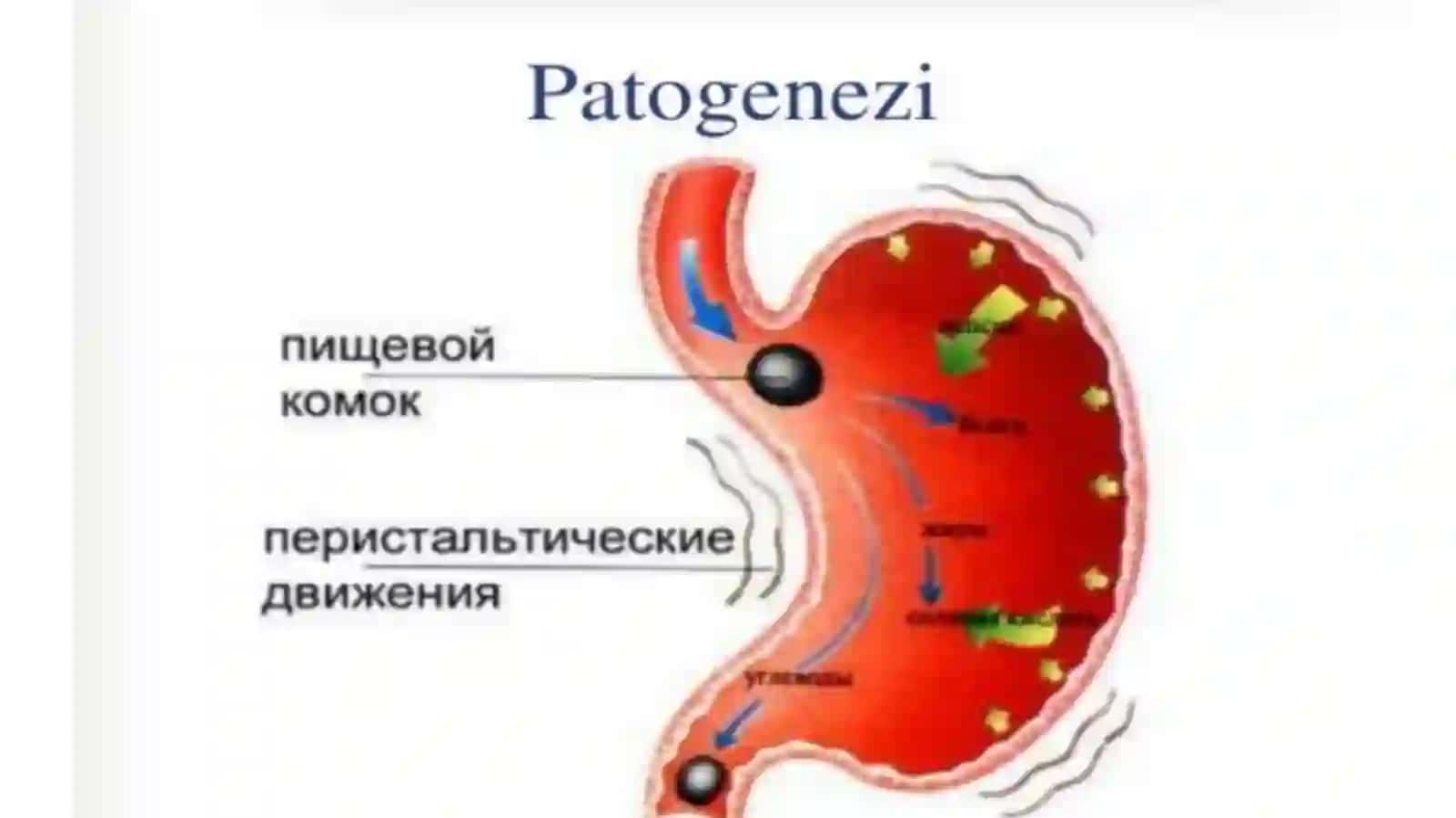 Oshqozonichak patologiyasi va oʻtkir va surunkali gastrit 3