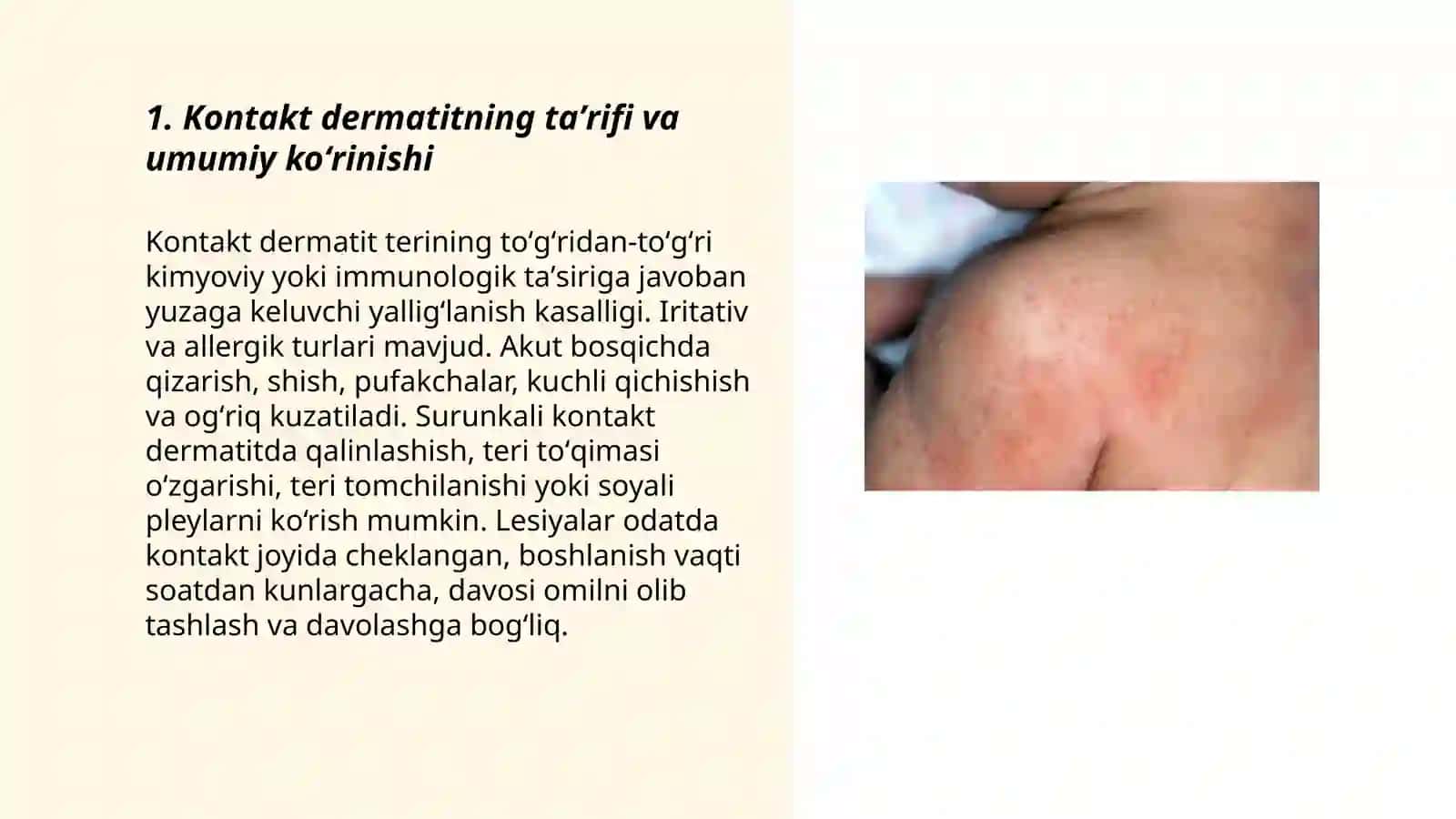 Kontakt dermatit 3
