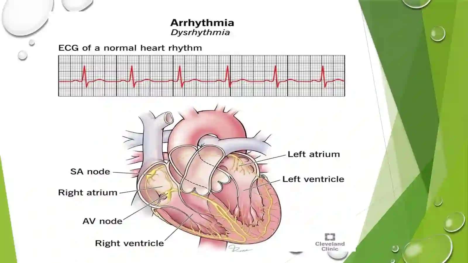 Yurak aritmiyalari EKG diagnostikasi 3