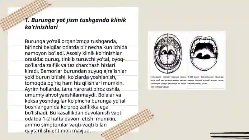 Burunga yot jism tushganda klinikasi, etiologiyasi, Differensial tashxis,va davolash 3