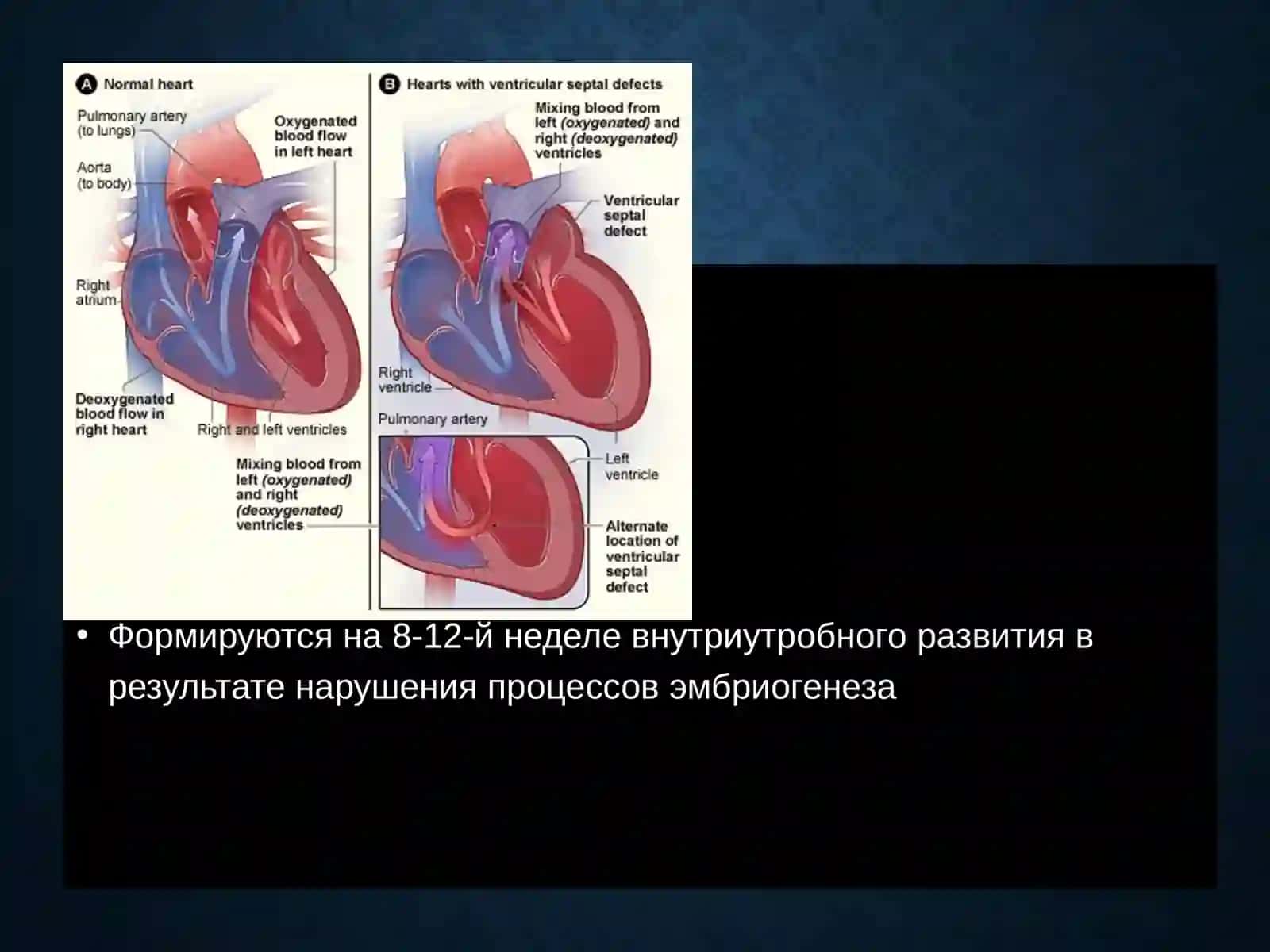 Врожденные пороки сердца у детей 3