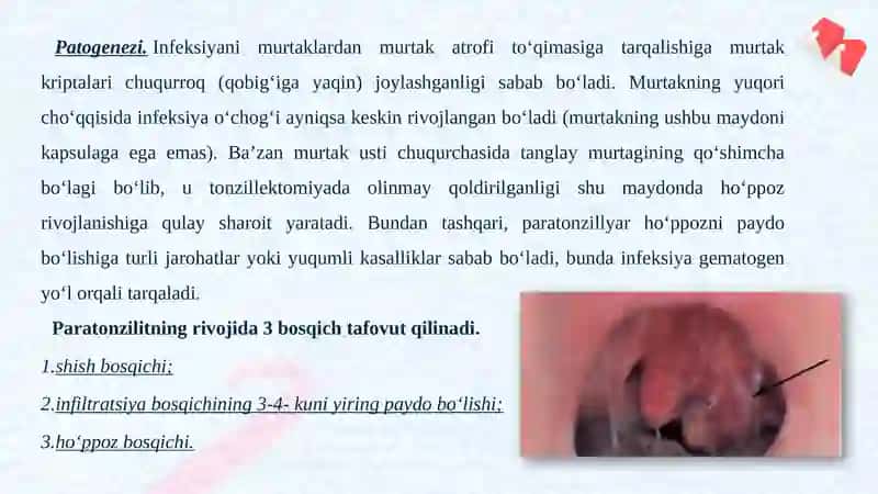 PARATONZILIT VA 8- TISH PEREKORONIT BILAN DIFFERENSIAL TASHXISLASH 3