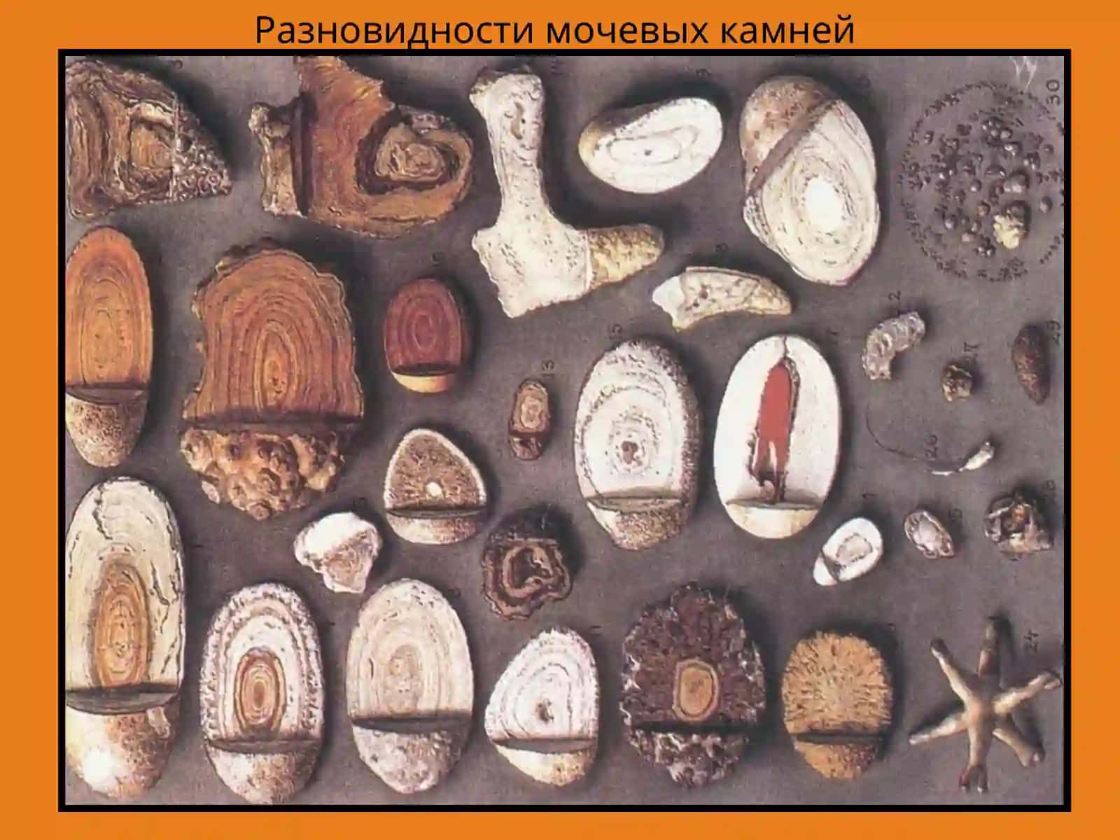 Мочекаменная болезнь (МКБ) 3