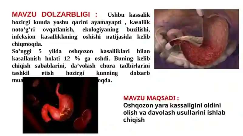 Oshqozon Yarasi Kasalligini Aniqlash va Davolash Usullari 3