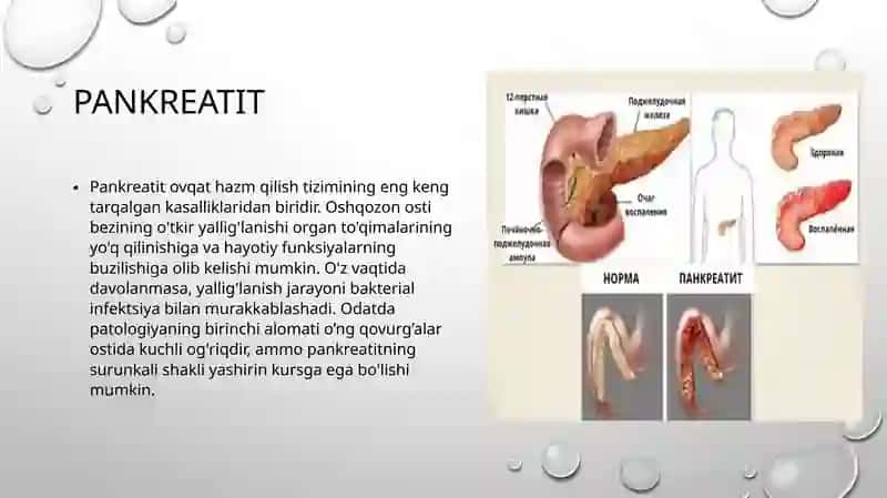 Pankreatit rivojlanishining biokimyoviy asoslari 3