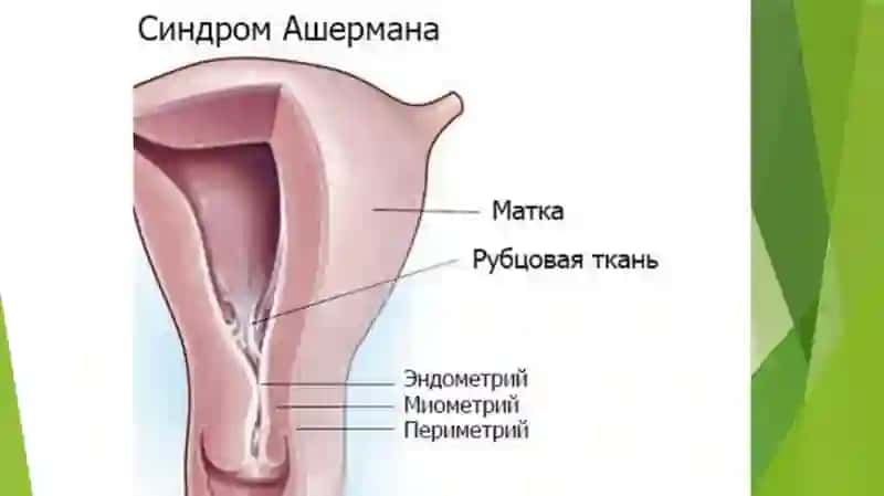 Asherman sindromi Ginikalogiya 3